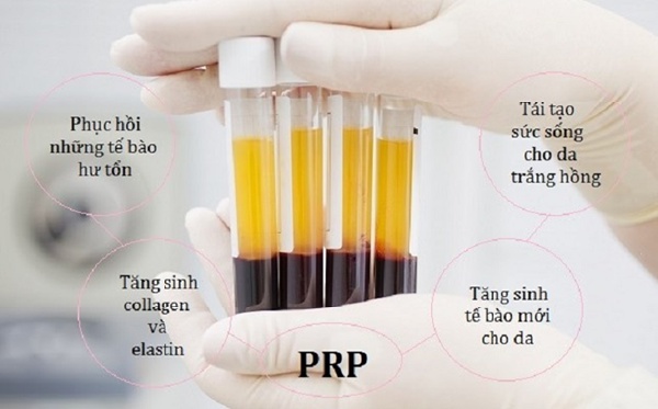 Huyết tương PRP là gì